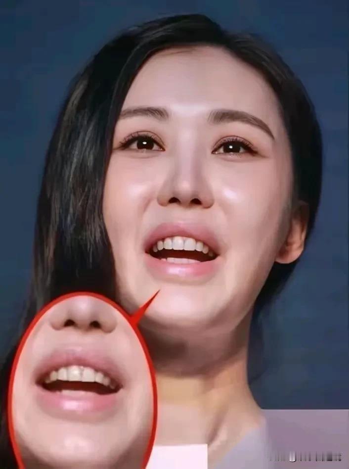这个女人的医美后遗症彻底爆发了，脸蛋凹凸不平，嘴巴也歪了，整张脸看起来非常怪异。