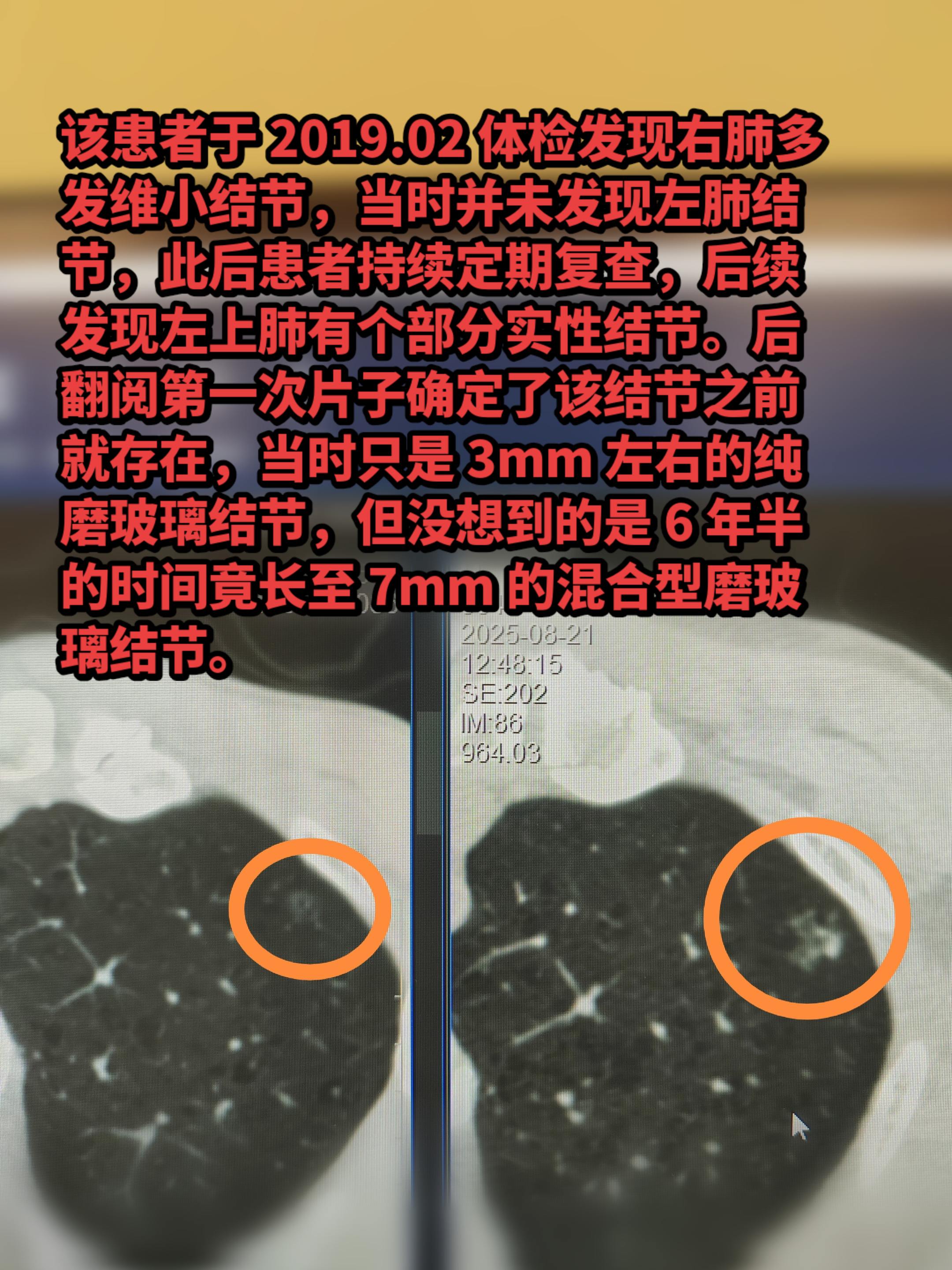 该患者于 2019.02 体检发现右肺多发维小结节，当时并未发现左肺结...