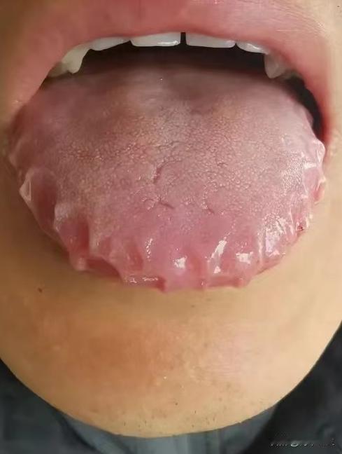 又是瓶盖一样的齿痕舌，这样的舌象不能只祛湿，早就没用了，就是不听，现在好了，肾脏