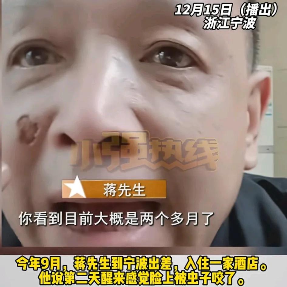 男子称住酒店被虫子咬出一个坑，过了几天面部红肿，越来越严重留下一个大的疤痕
感觉