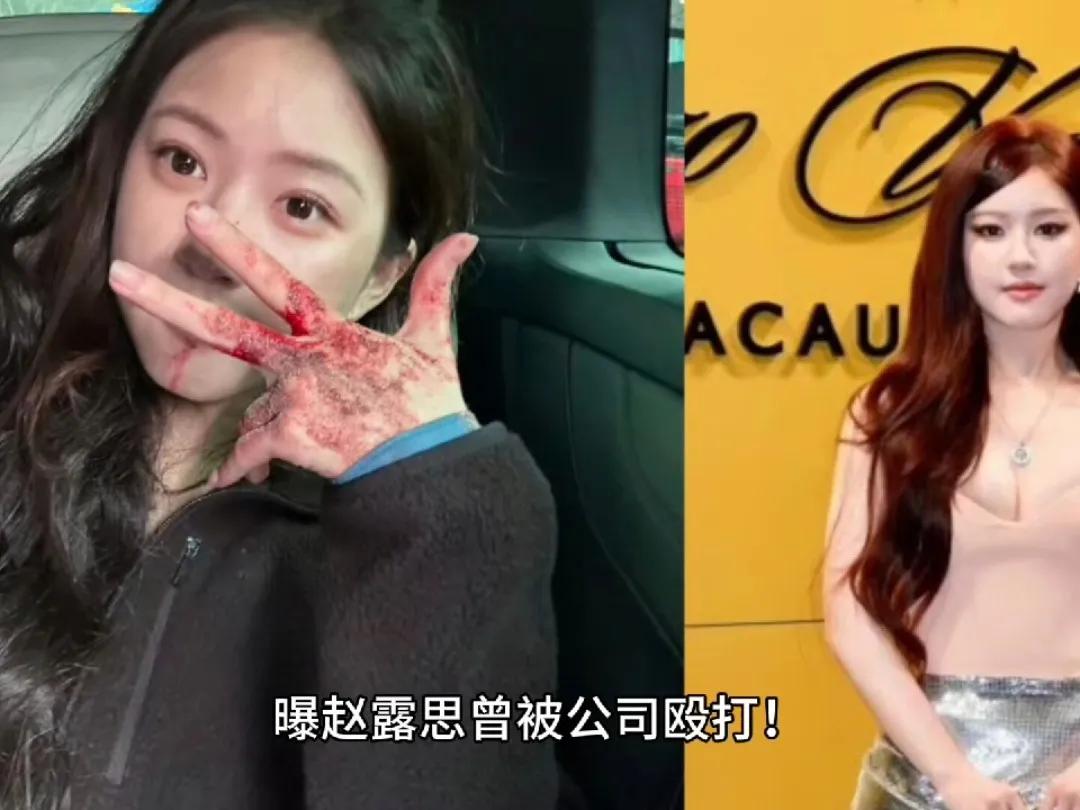 赵露思被打是假？公司回应引争议：网友炸锅‘谁在说谎’！一边是赵露思亲口承认被殴打