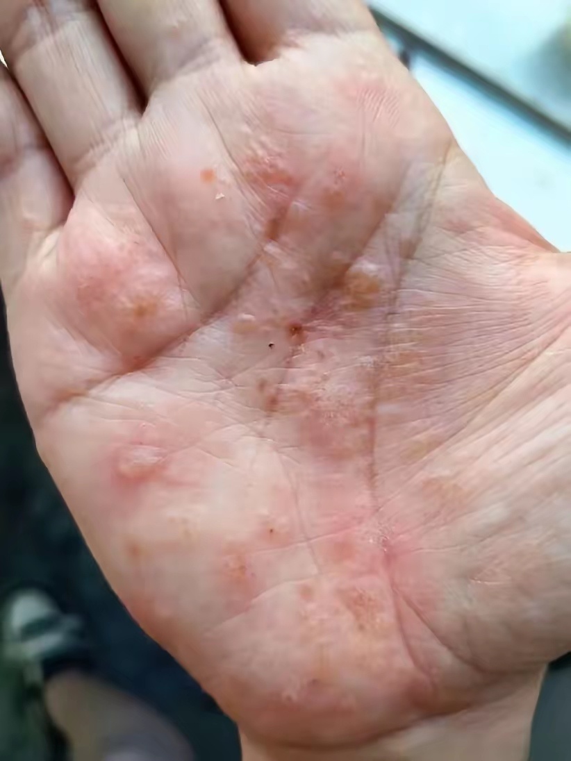 网友：手心莫名其妙起的这是什么啊！越挠越多，特别痒，要疯了，有知道的吗？ 