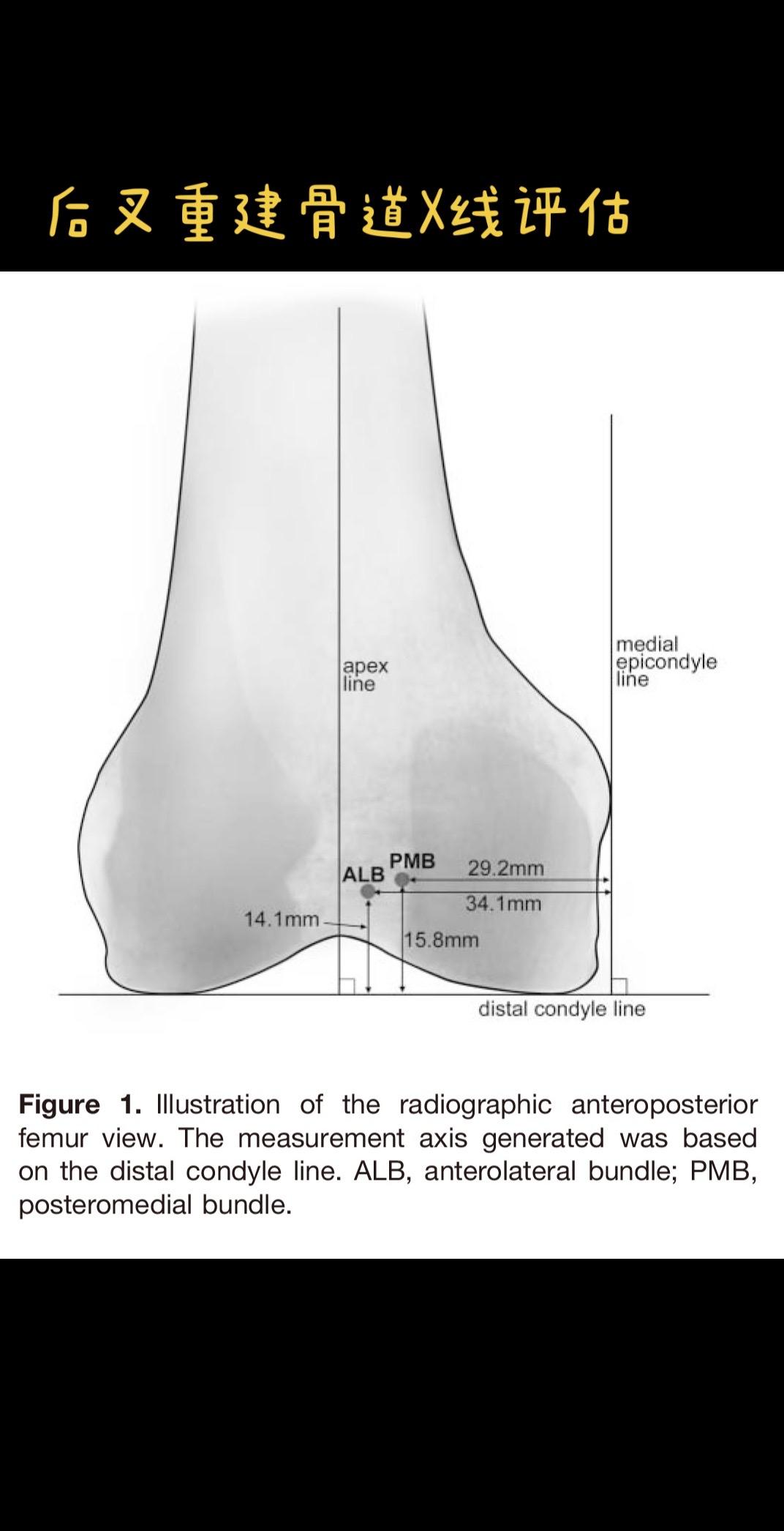 后交叉韧带重建，骨髓道X线评估。