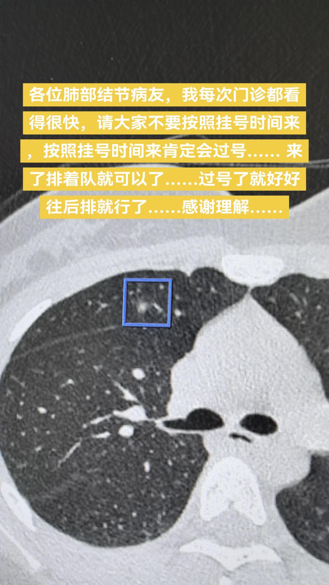 挂号看肺结节的病友。各位肺部结节病友，我每次门诊都看得很快，请大家不要...