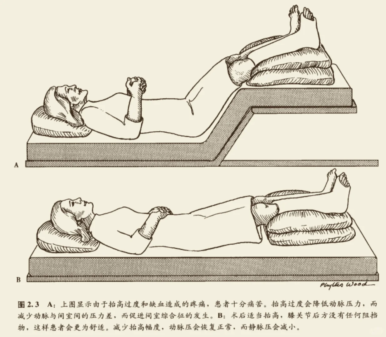 拇外翻术后抬高问题