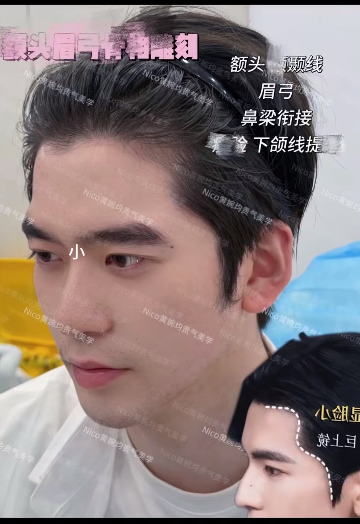 赵樱子弟弟整成张凌赫了有一丢丢像，就是脸上胡子拉擦不怎么干净 