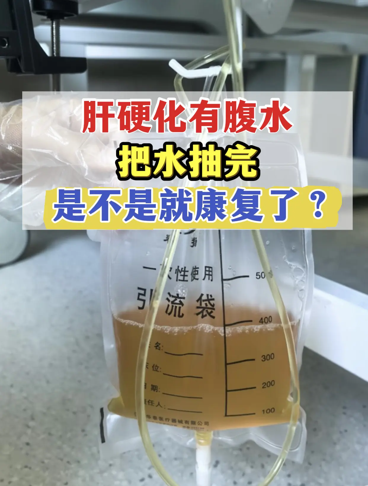最近门诊收入一个肝硬化腹水的患者，来的时候走路都困难，肚子里腹水有11...