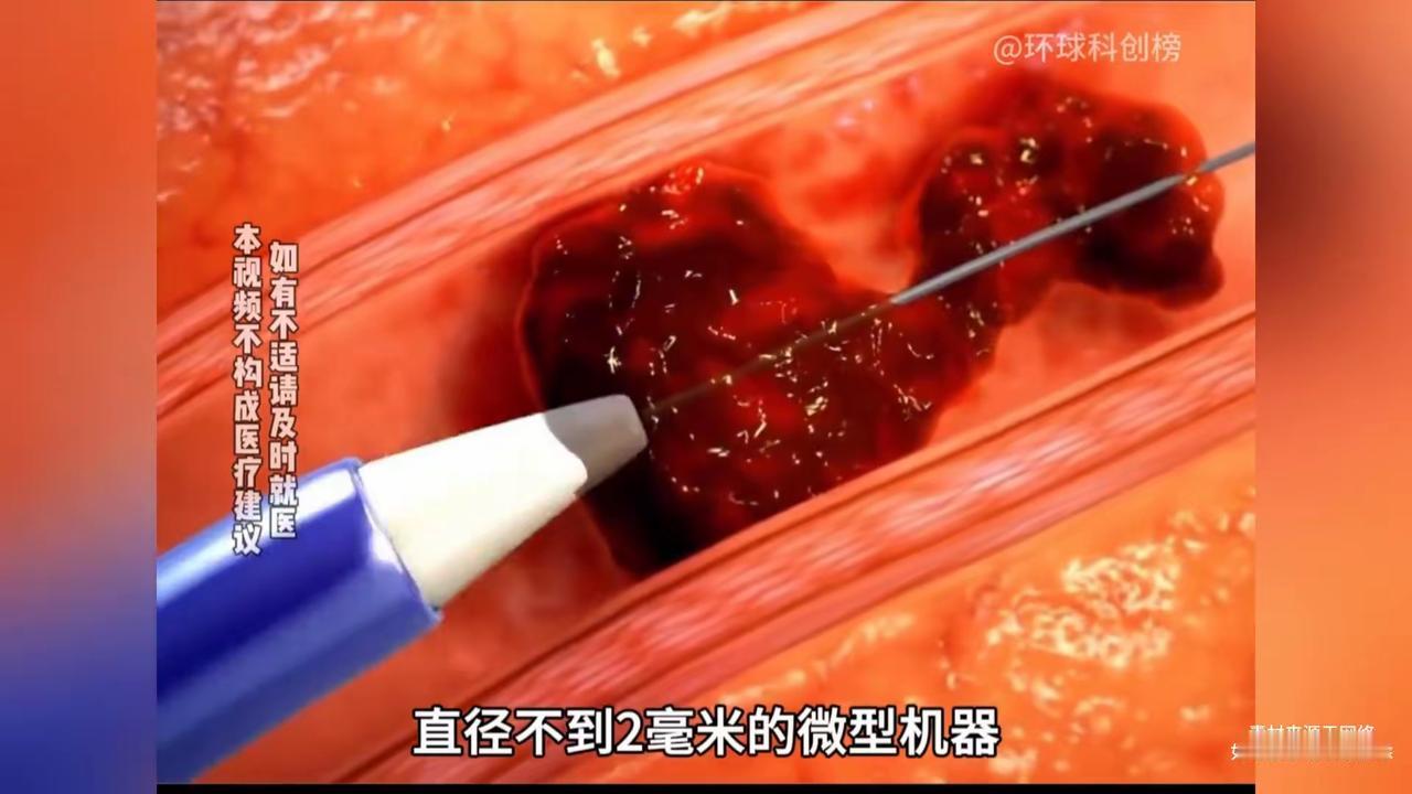 中国90后女博士造出清血栓机器人！把脑梗心梗“血管炸弹”连根拔起，这才是国之重器
