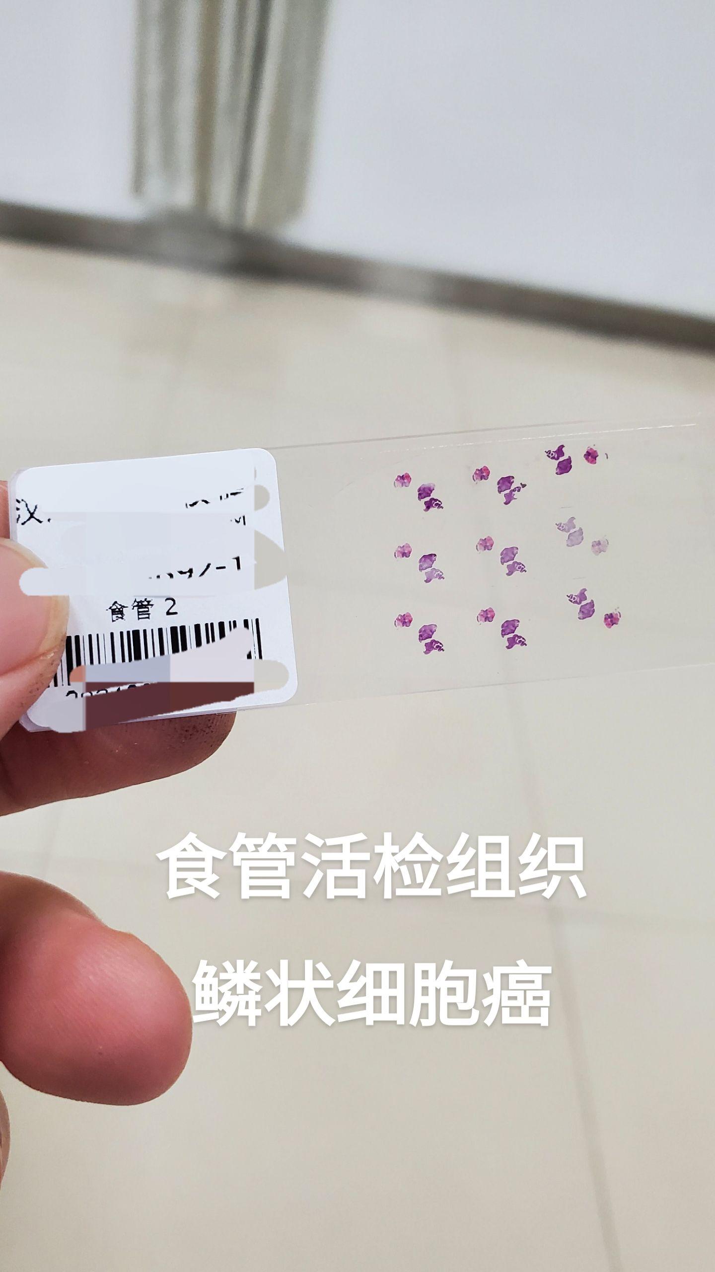 食管鳞状细胞癌