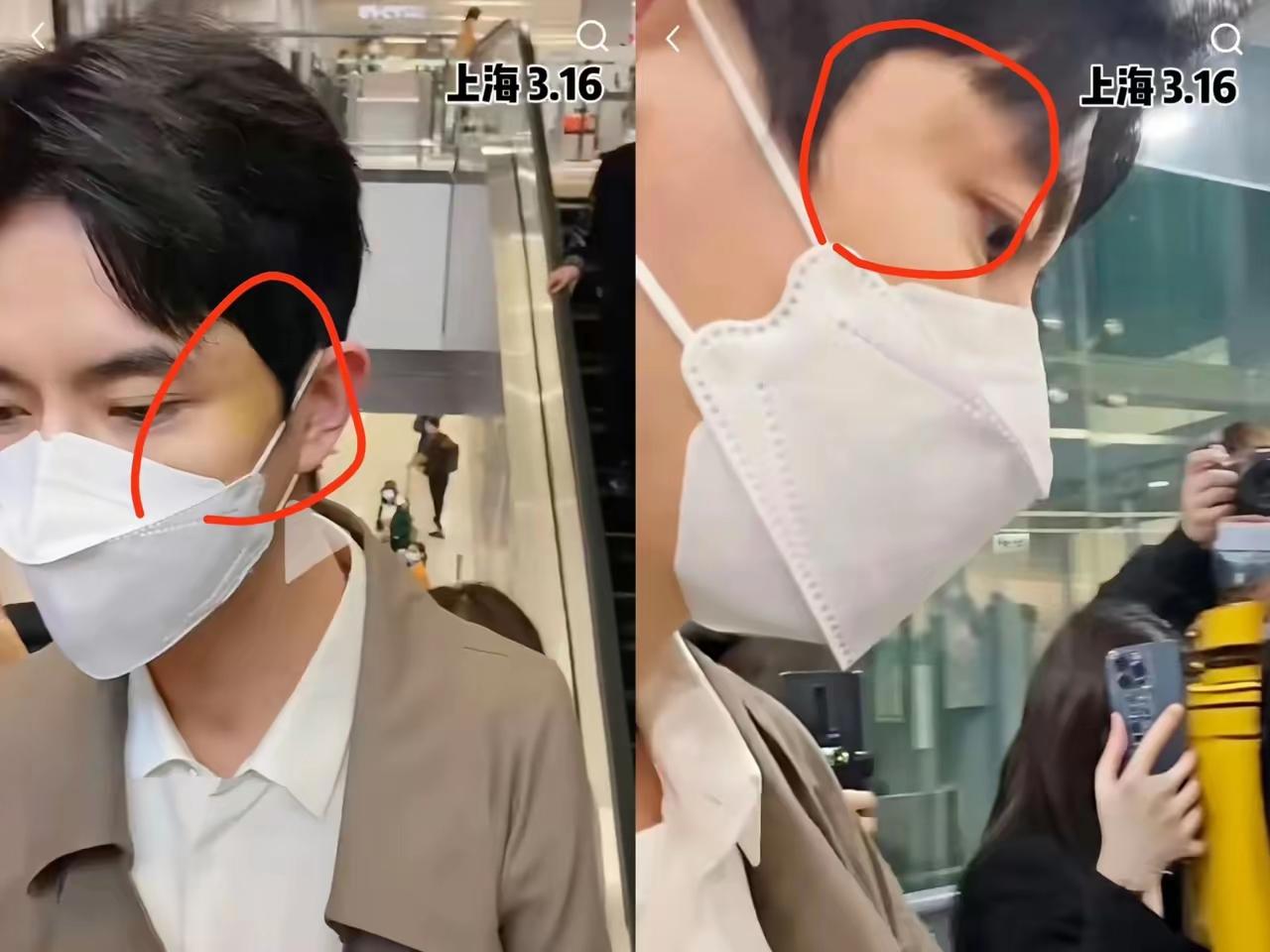 以下是一篇相关的今日头条爆款文章：
 
男星脸上淤青反复出现？早有迹象引猜测
 