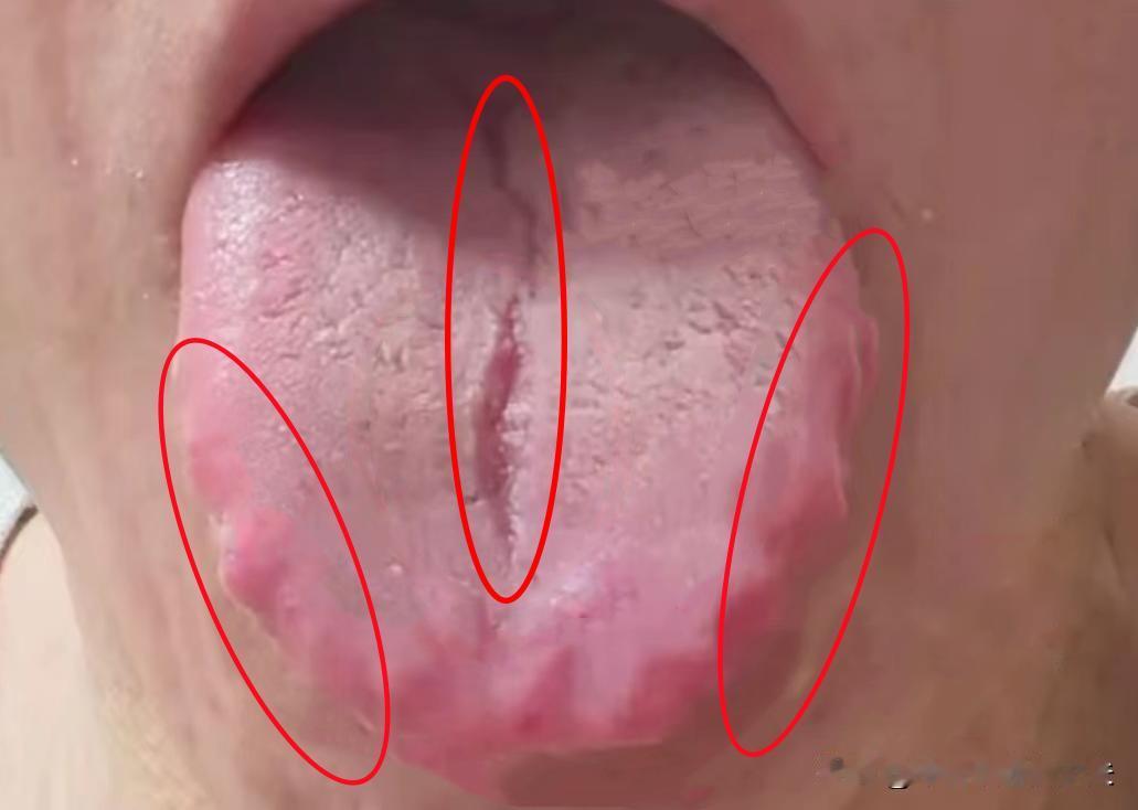 舌头有裂纹，裂纹还很多？天天健脾还没用？时间还短怎么办？
裂纹舌是很常见，但是想