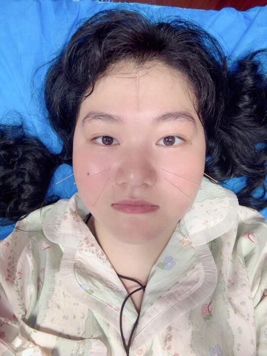 鼻炎尝试一下针灸