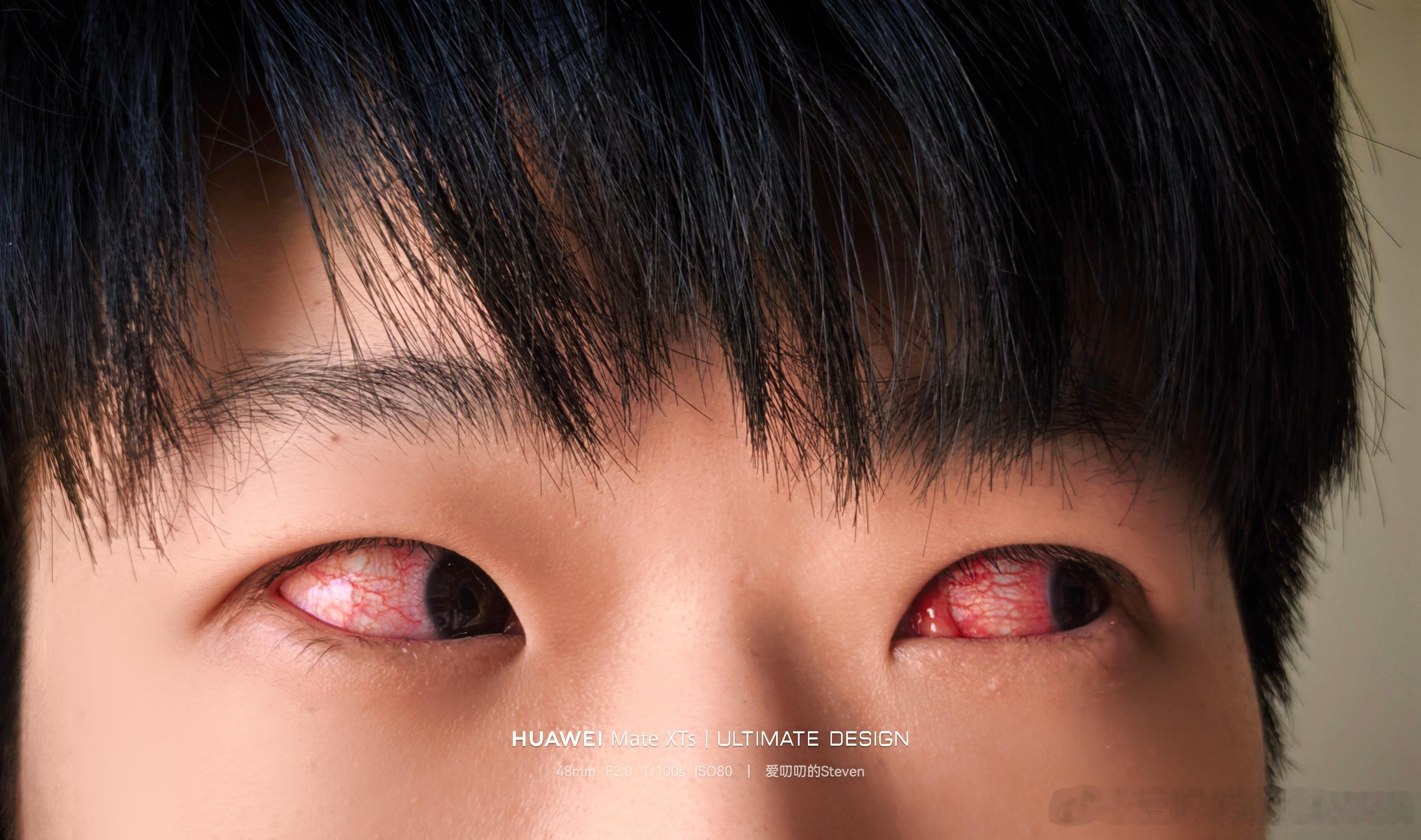 泄露了天机太多，遭到天道反噬了……熬了几个大夜，急性结膜炎了爱叨叨的日常