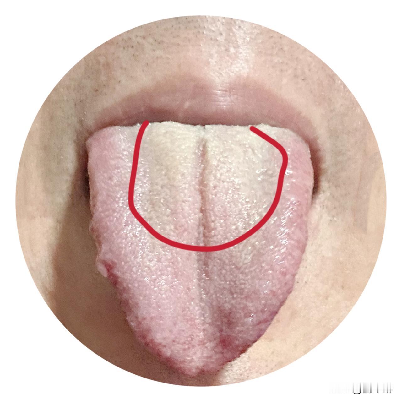 疫情期间患上的，吃了5年的中药，一直不见好！看了几次西医，医生说没大碍！
我现在