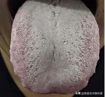 舌见白厚腻苔伴齿痕？湿食胶结困中焦，平胃散为破局良方
 
伸出舌头照镜，若见一层
