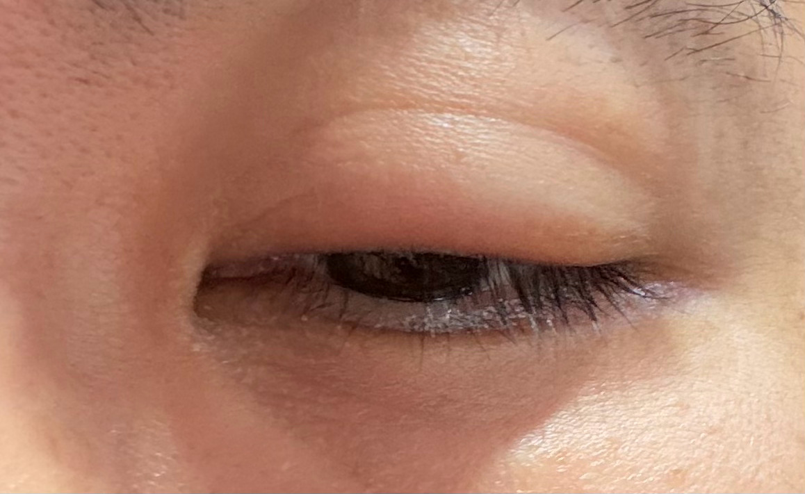 睡了10小时后眼睛肿了。