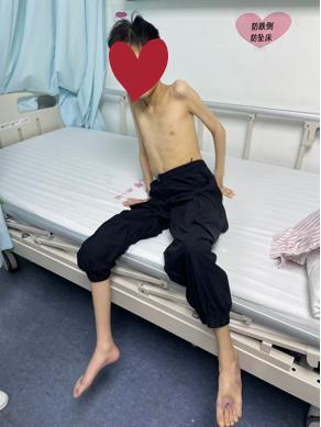 太让人揪心了！广州，一17岁男子，体重却只有21.2公斤，身体瘦弱到极致。常年卧
