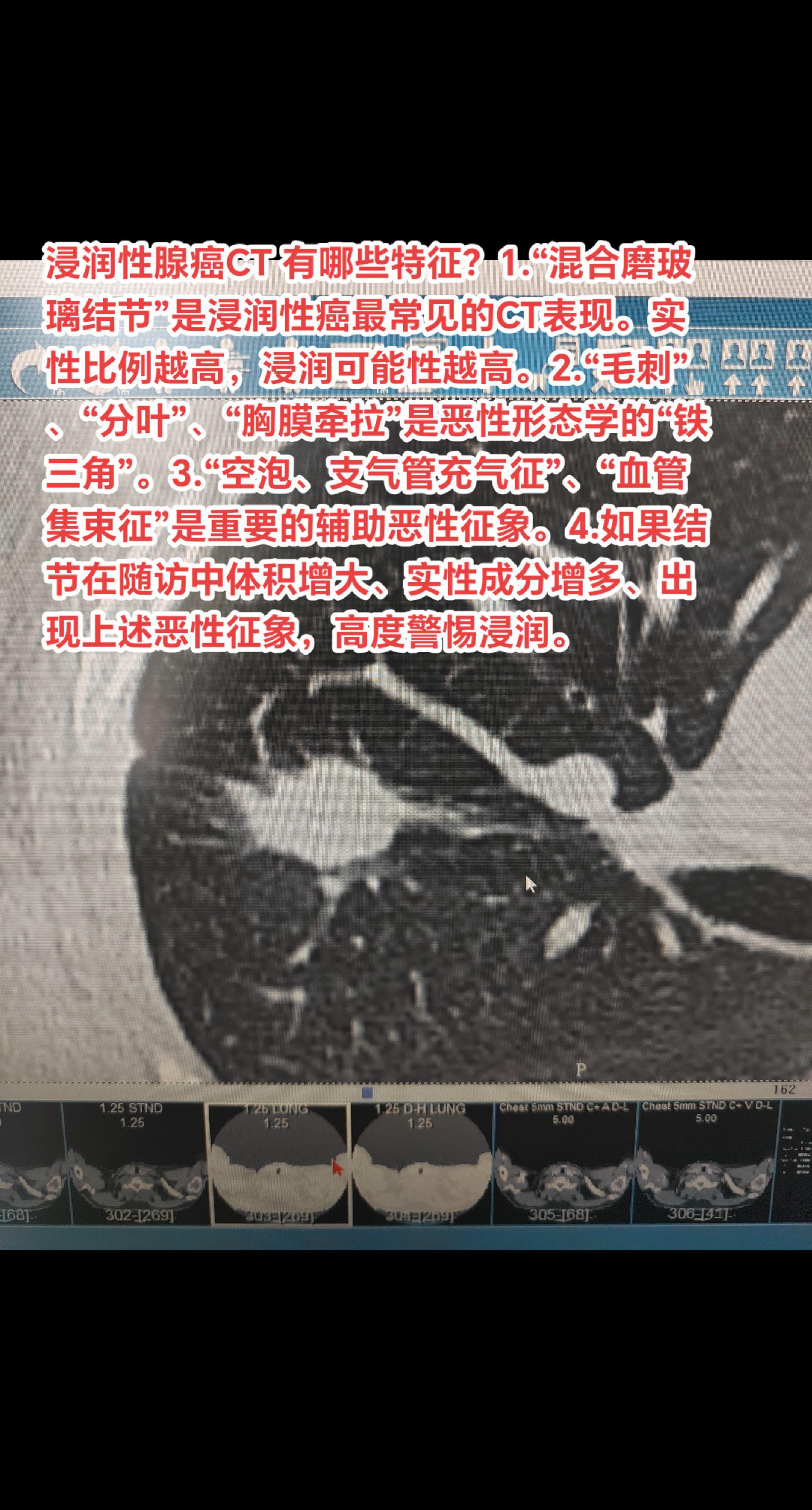 浸润性腺癌CT 有哪些特征？1.“混合磨玻璃结节”是浸润性癌最常见的C...