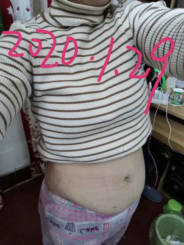 这起新闻的当事人是30岁的瞿女士，她在剖腹产后因突发脑梗导致失明。你在热议这件事