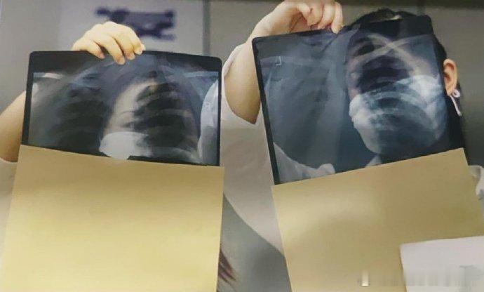 2003年非典期间，医生查看病人的肺部x光图 