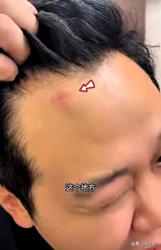 这两哥们真倒霉，去墨西哥看个世界杯，没想到下飞机就被抢劫了！额头被劫匪用枪给顶破