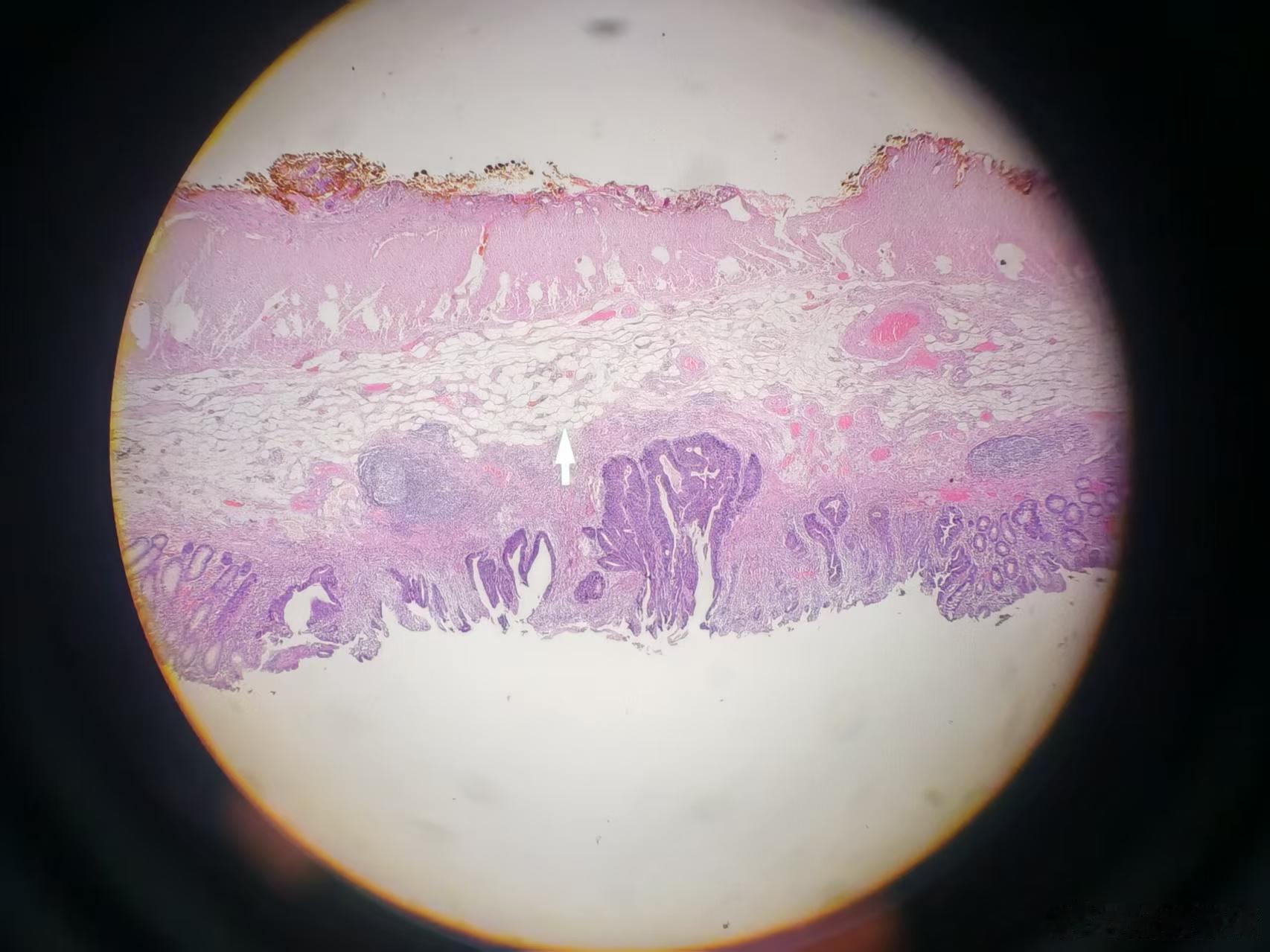 胃窦早癌：1. 组织类型：以管状腺癌最多见，其次乳头状腺癌；低分化腺癌、印戒细胞