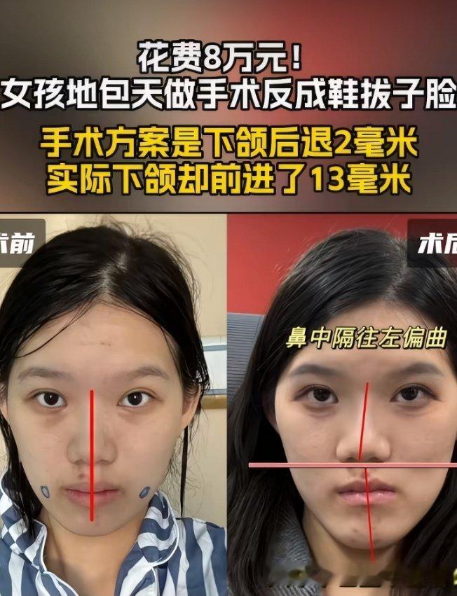 正颌手术被做反女孩术后直接失业原本只是轻微地包天，为了更好做模特选择正颌手术，谁