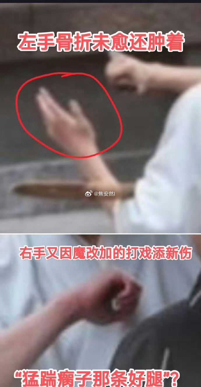 我天，杨洋手竟然还这么严重 