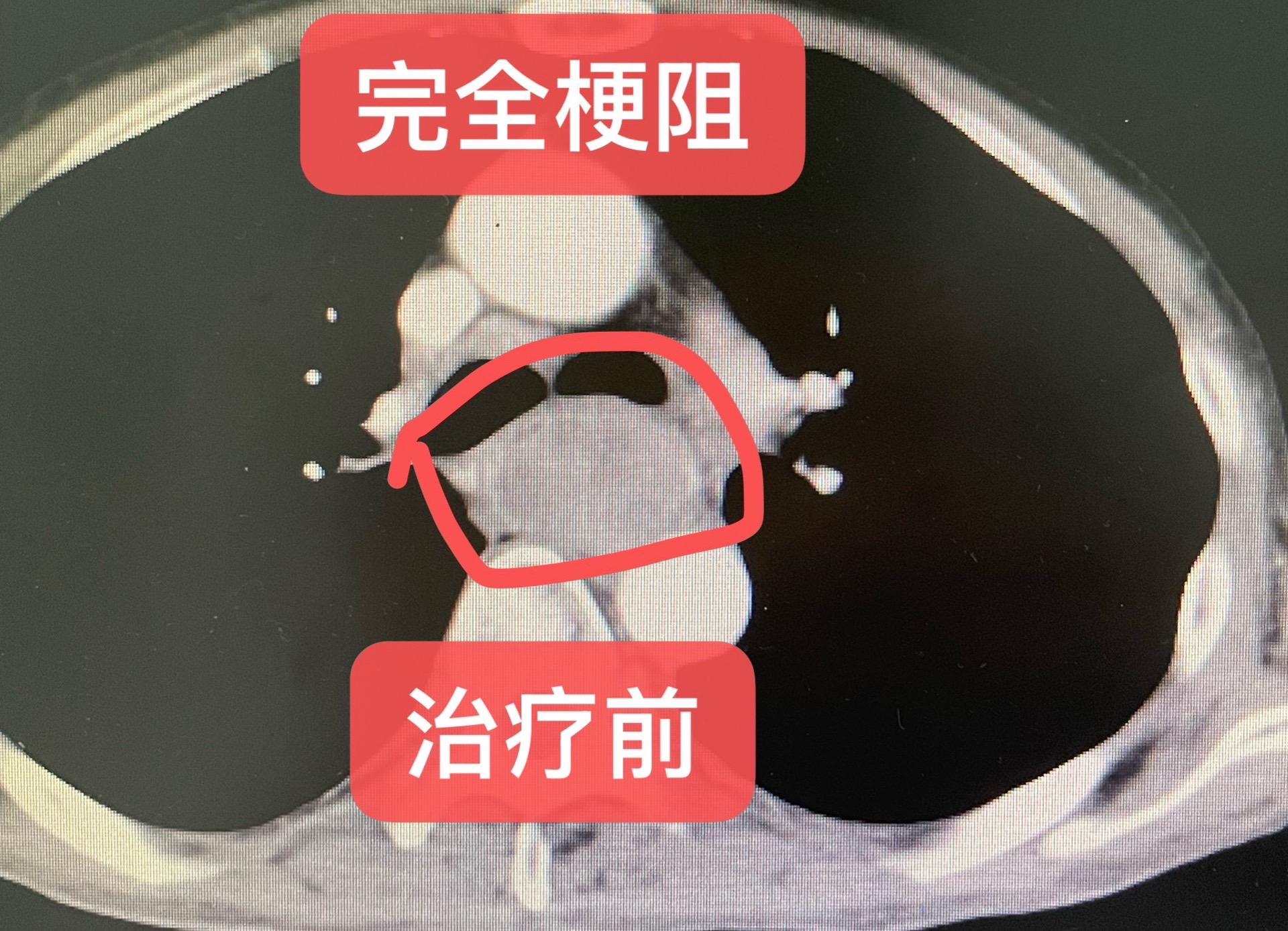 晚期食管癌多节段的治疗。IV期食管鳞癌，锁骨区域，纵隔，肝门腹膜后转移...