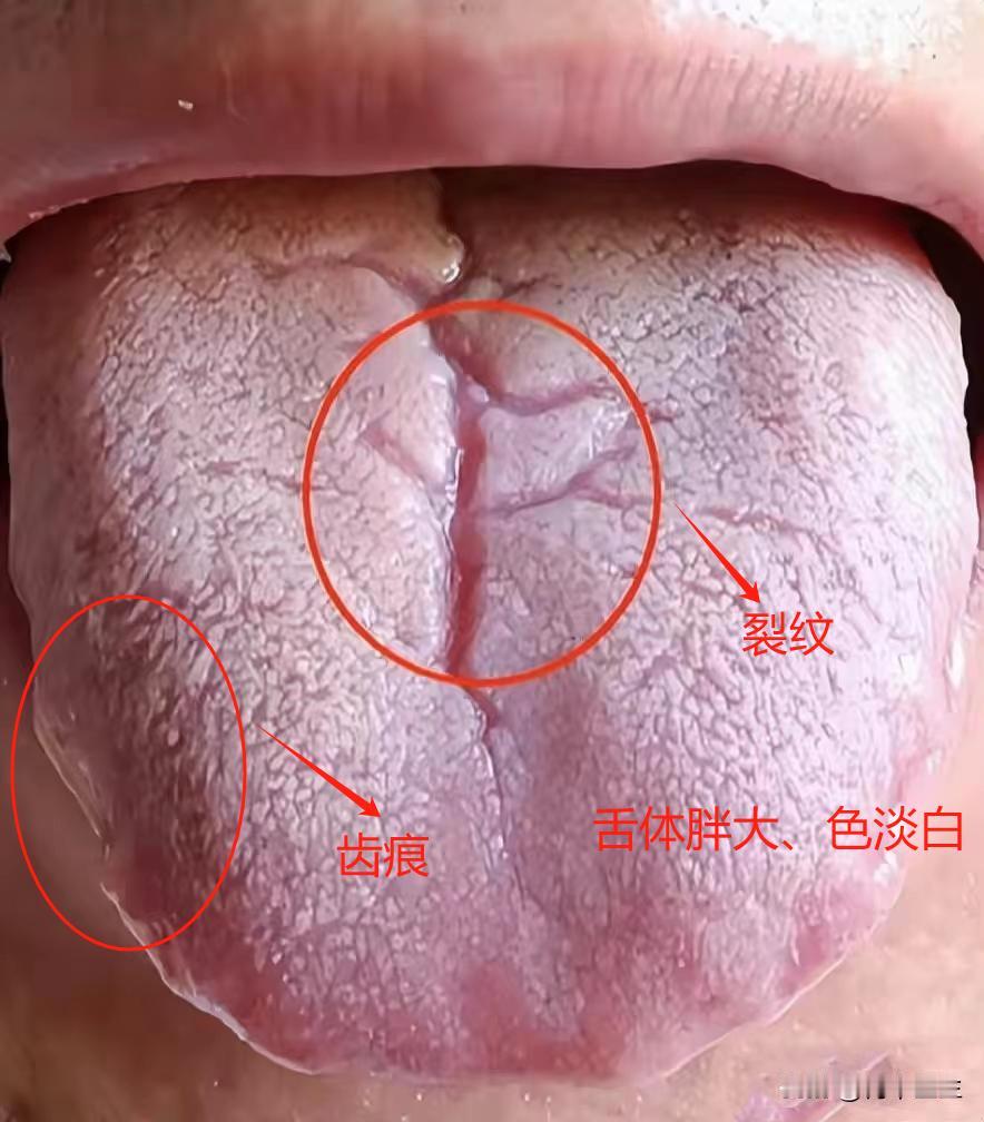 舌头快变成地图了还不在意，脾胃都快扛不住了

昨天看诊了这样一位患者，说自己食欲