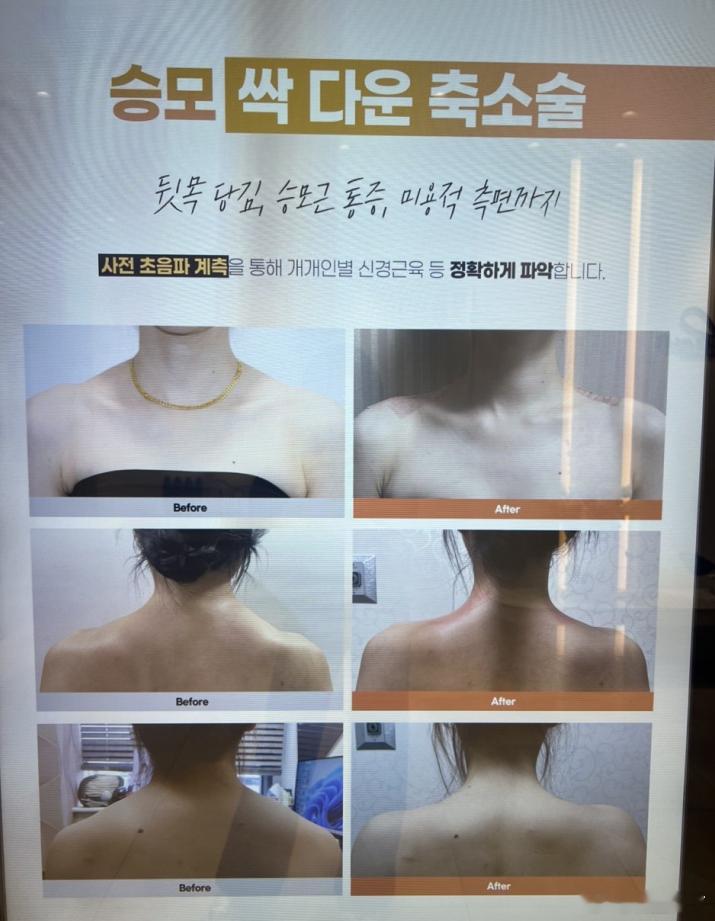韩女超级出圈的天鹅颈套餐：肌肉阻断+抽脂+去富贵包，一共不到3w 