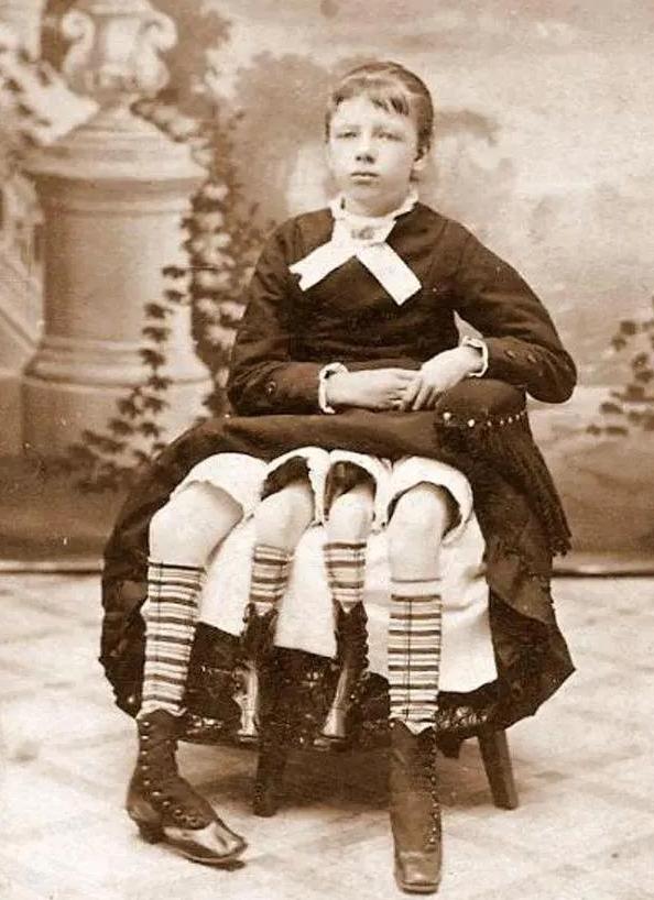 1868年，美国一个长着四条腿和两个生殖器官的女孩，被父亲高价卖给马戏团，女孩不