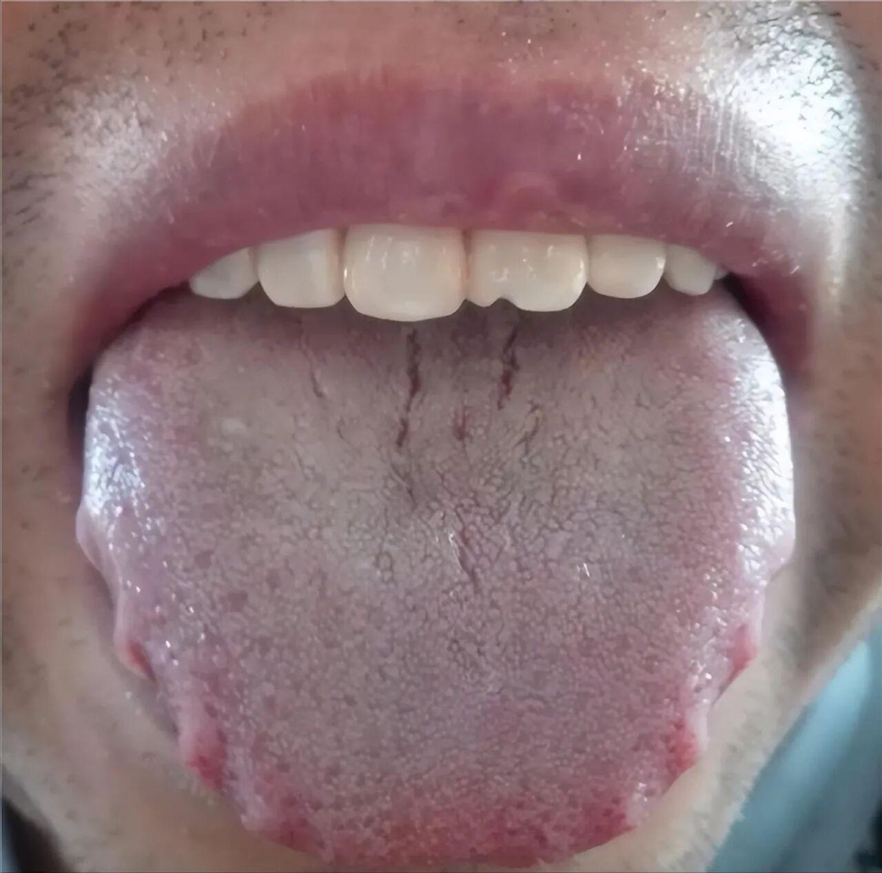 中药调理湿气：脾湿时间短
针对湿在肝导致的阴囊潮湿，你可以尝试使用龙胆草、车前子