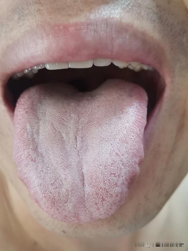 舌边齿痕，舌苔白腻，很多人一看就去健脾了[黑线][黑线][黑线]
但是，你真的辩