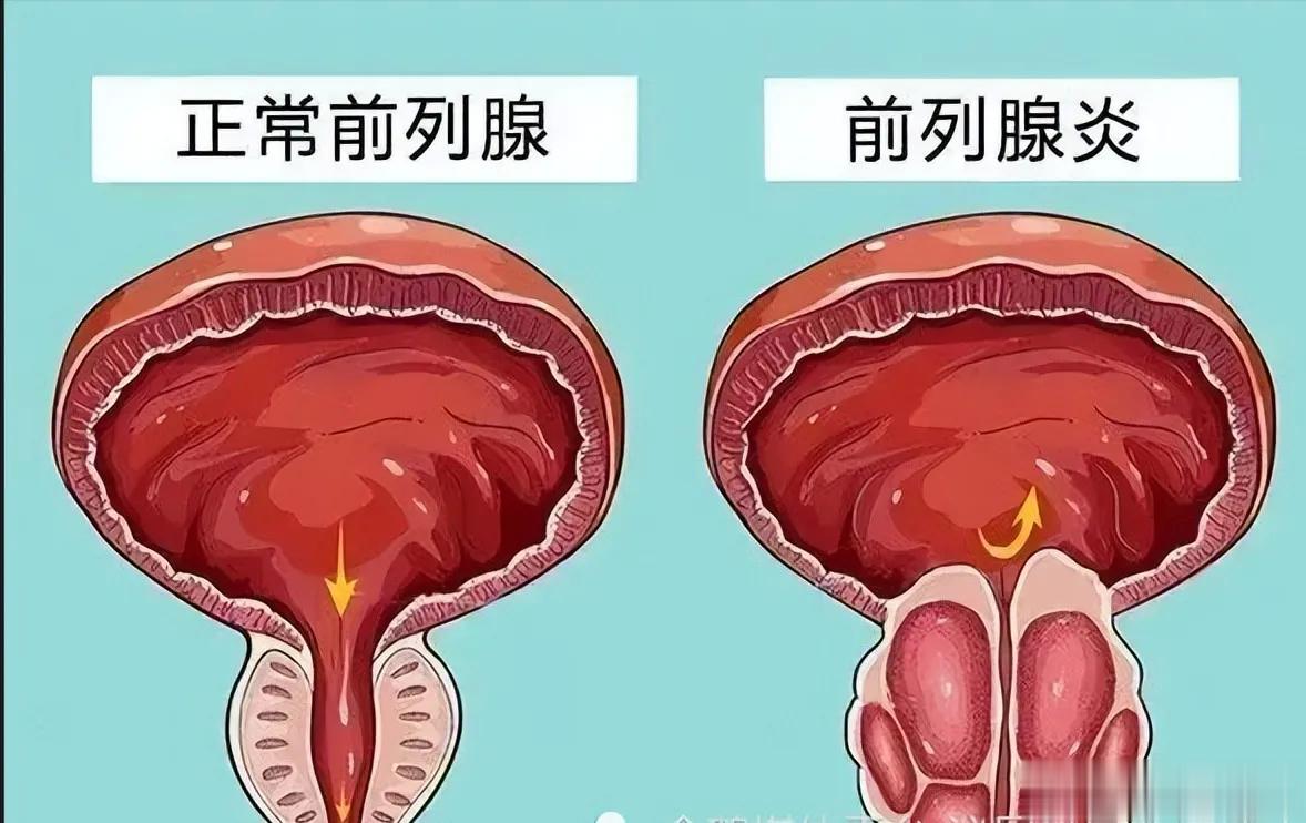 前列腺炎能治好吗？前列腺炎在临床上很常见，常见于15-45岁的男性。由于前列腺炎