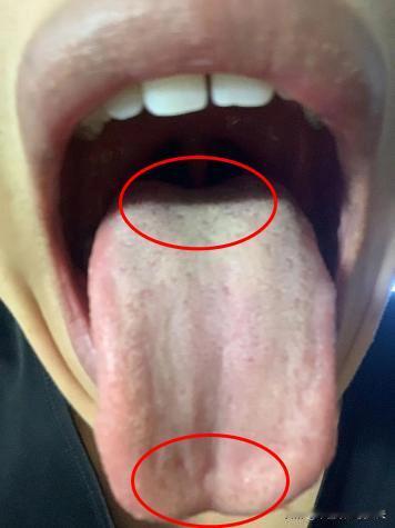阴囊潮湿、大腿根出汗？两个中成药：金匮肾气+二妙散，祛湿清热！
最近有一位粉丝，