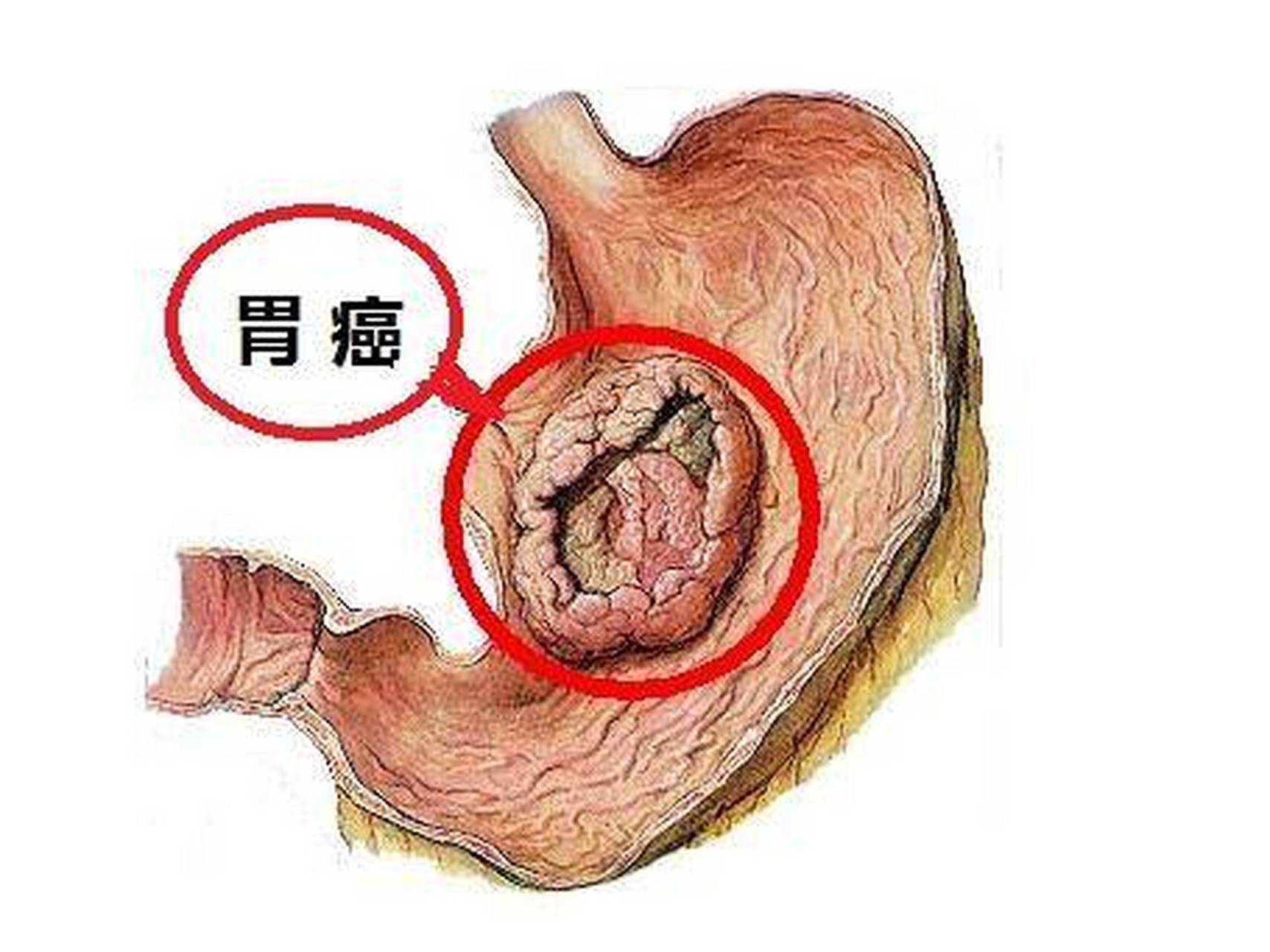 得胃癌前胃会经历什么  健闻登顶计划  胃癌关爱日  今天是中国🇨🇳第六个“