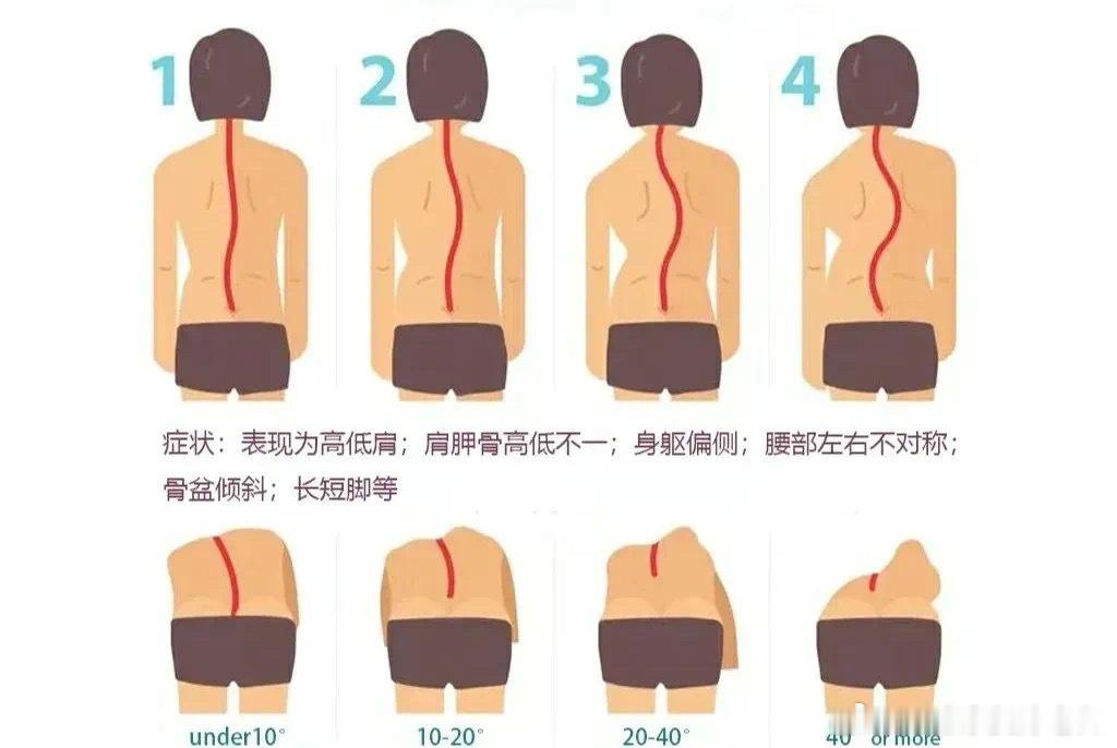 脊柱侧弯  最近一到周末，就会有不少家长带着孩子来康复，问题也集中在体态问题和膝