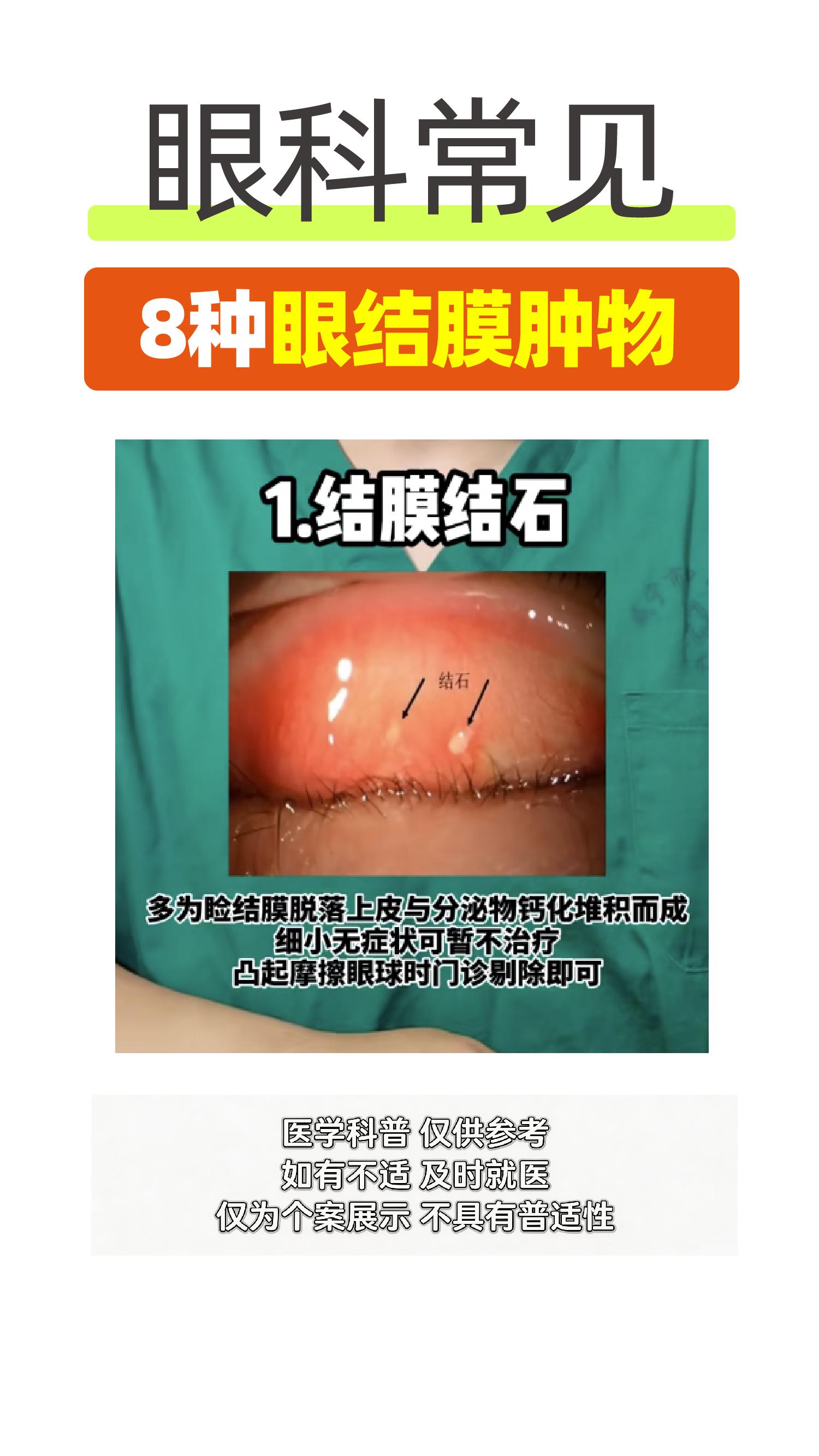 眼科常见-8种眼结膜肿物。