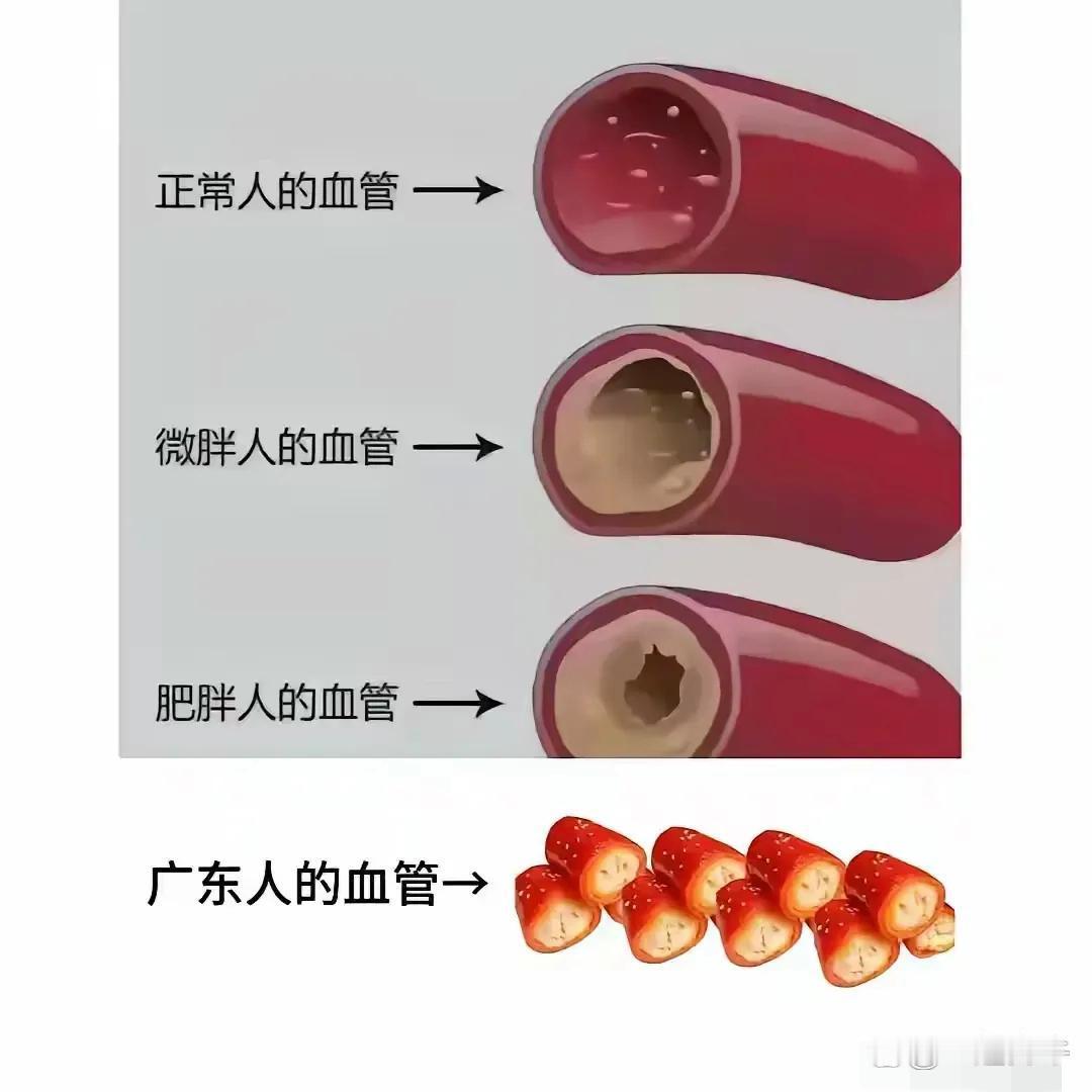 广东人的血管为什么会这样？ 