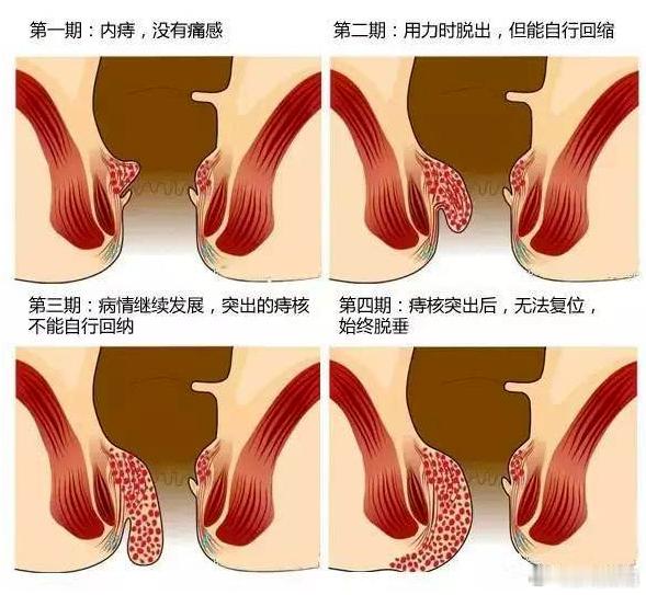 内痔：I度：内痔需要经过肛门镜检查确诊，表现为局部有痔核形成，病人也会出现排便带