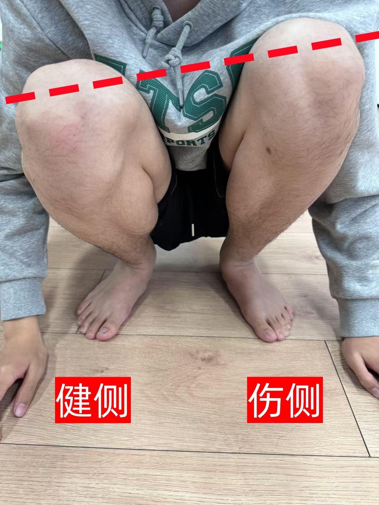 骨折康复 大家有没有听说过大腿骨折，这种情况一般是暴力外伤导致的，相对严重，北京