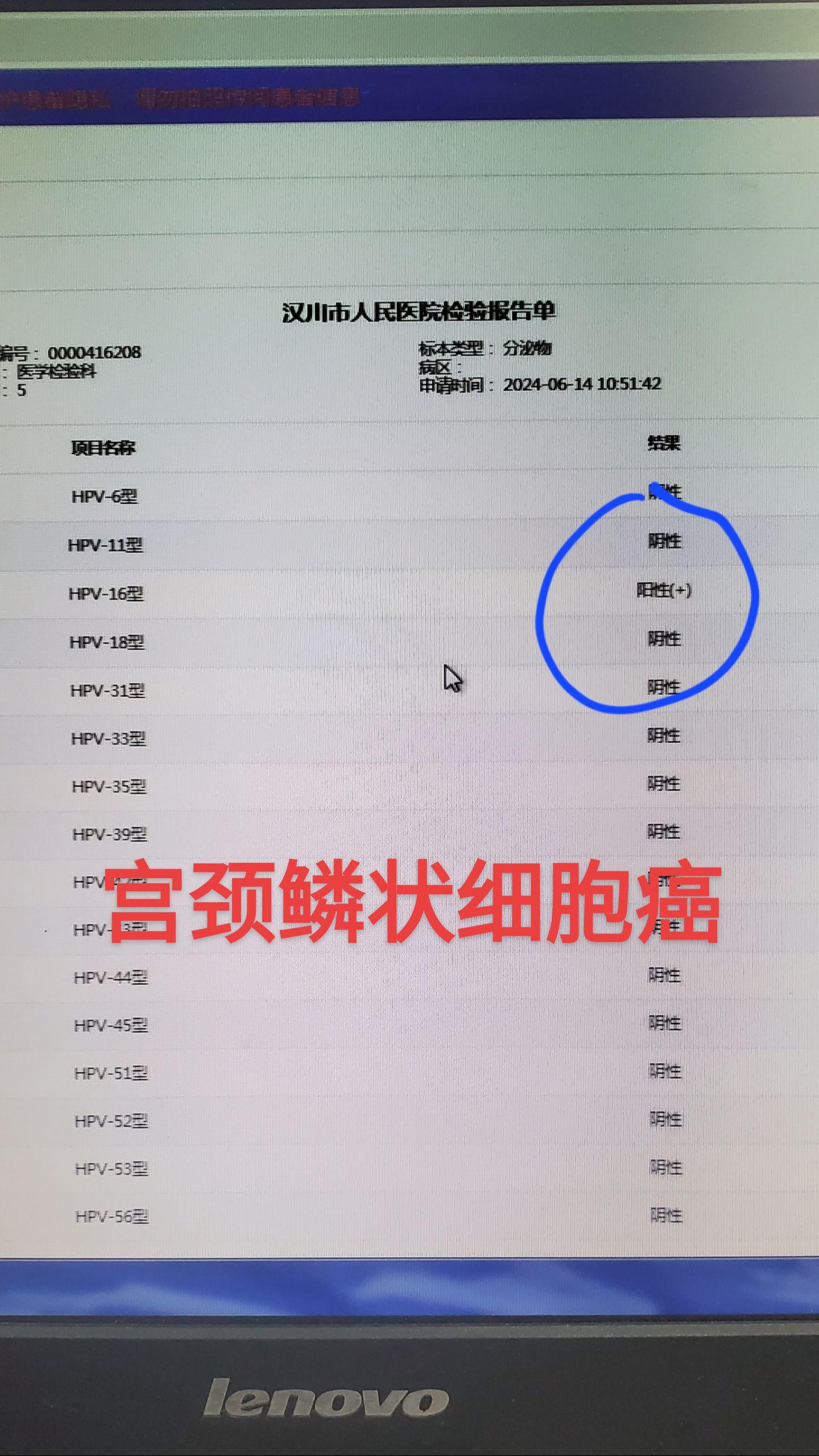 宫颈活检 鳞状细胞癌