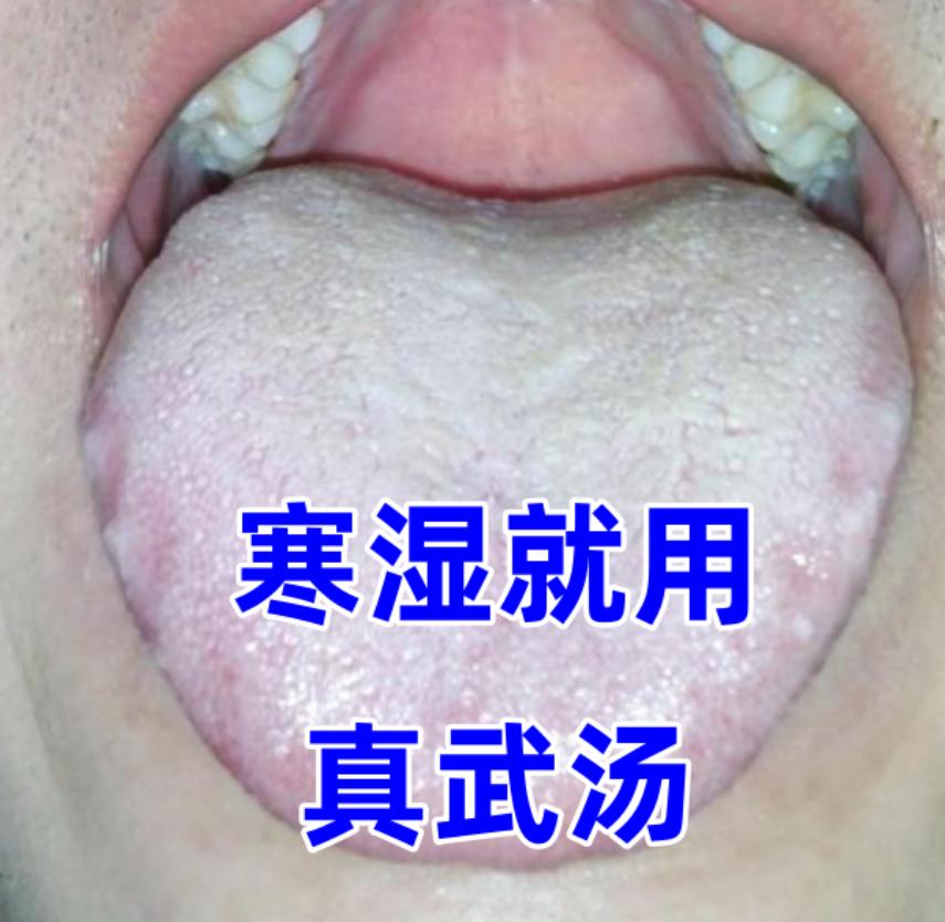 张仲景的三大治水方：猪苓汤，五苓散，真武汤，分别对应湿热，痰湿，寒湿

1、真武