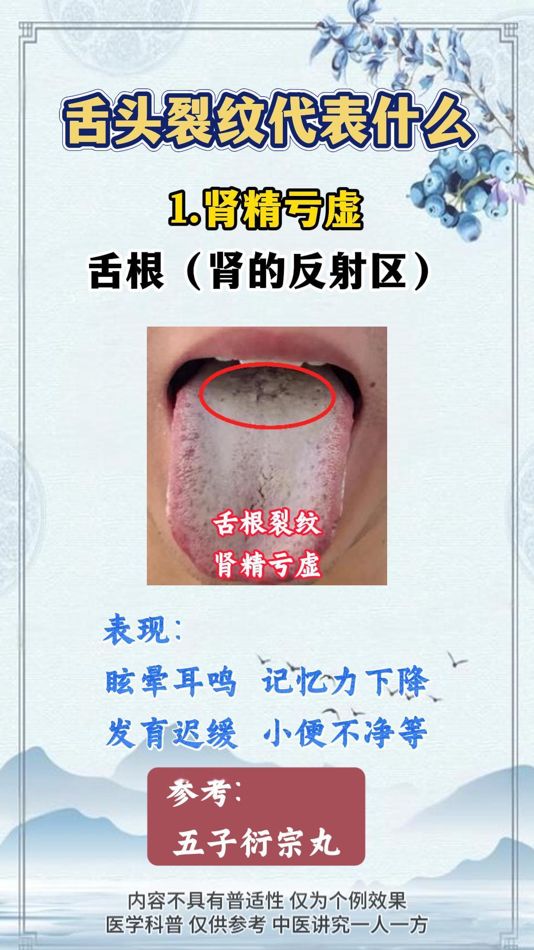 舌头裂纹代表什么。