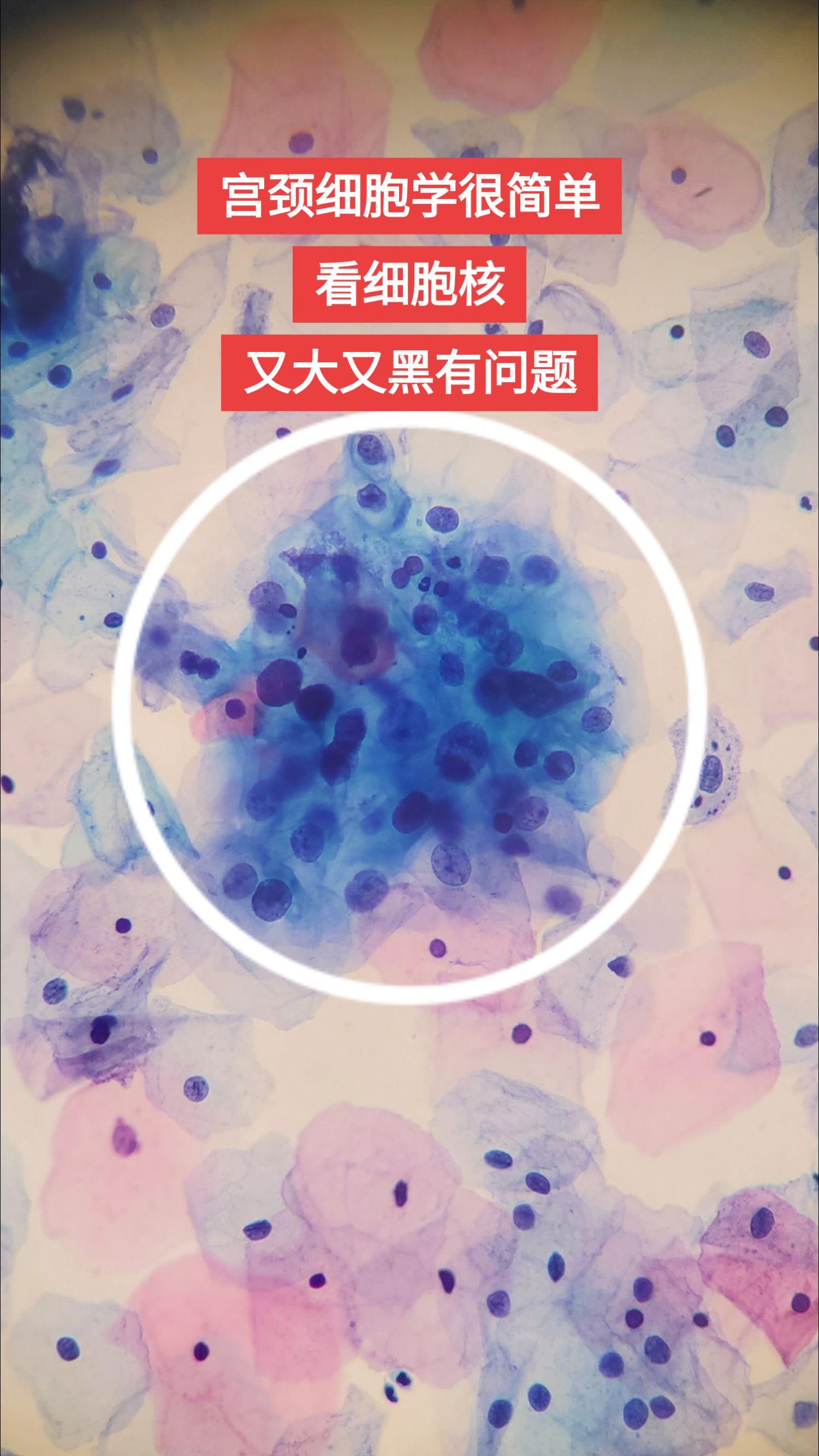 <p>hpv感染  宫颈 </p>