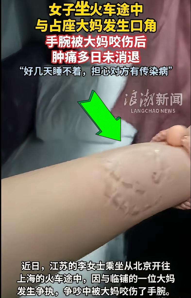 细思极恐！火车上铺大妈霸占乘客下铺，争执后张嘴咬人。事后被咬女士手腕肿胀，牙印附