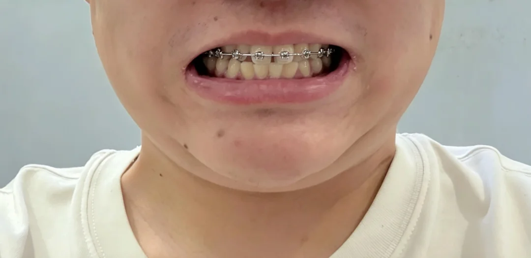 正畸一年没长黑三角，分享清洁经验