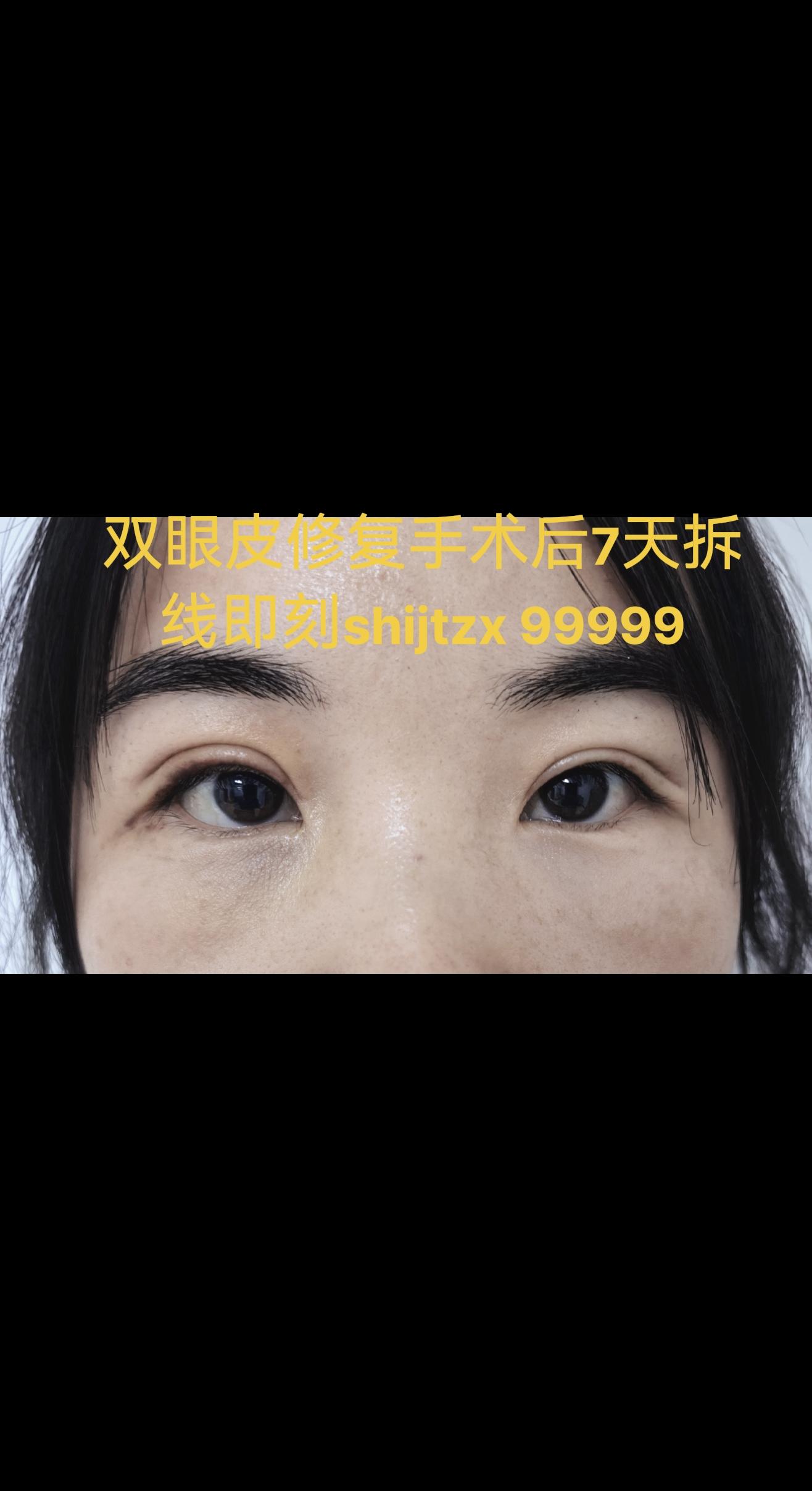 双眼皮修复手术。