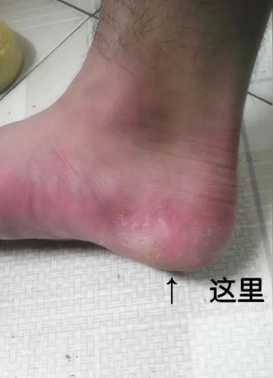 把砖烧热，砖上铺一层干草，把脚后跟踩上边，一定要人能承受了的情况下，一周两次，两